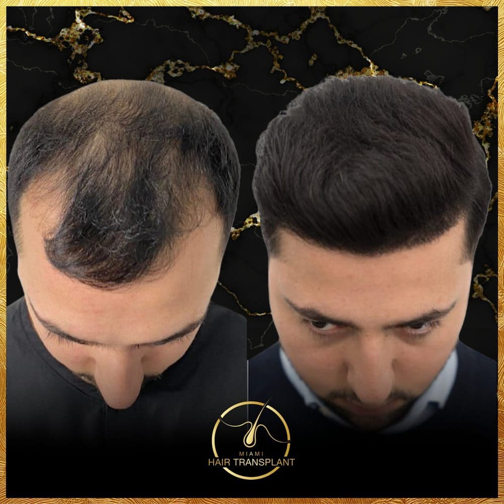 Miami Hair Transplant