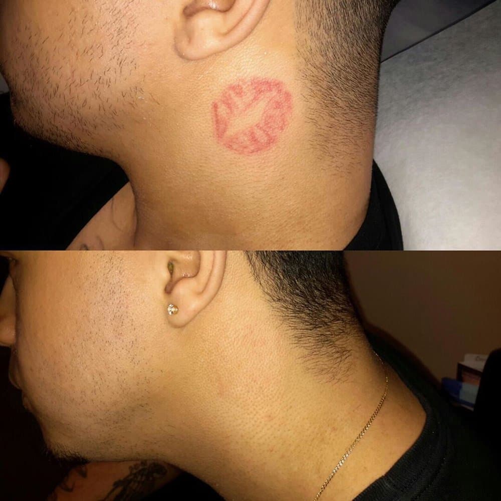 Winter Park Tattoo Removal