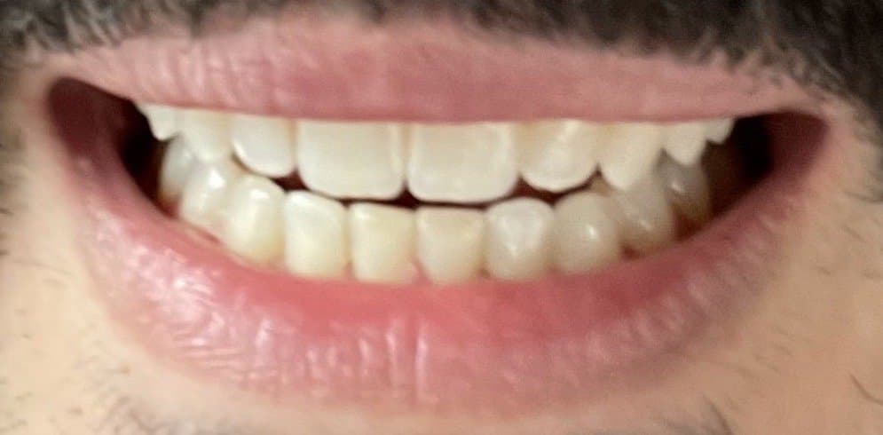 Wise Braces