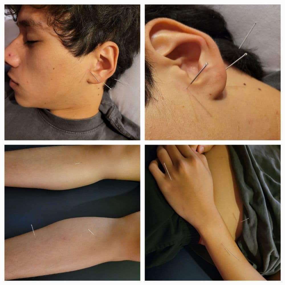 Longevity Acupuncture