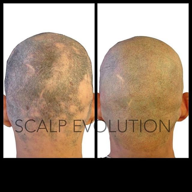 Scalp Evolution