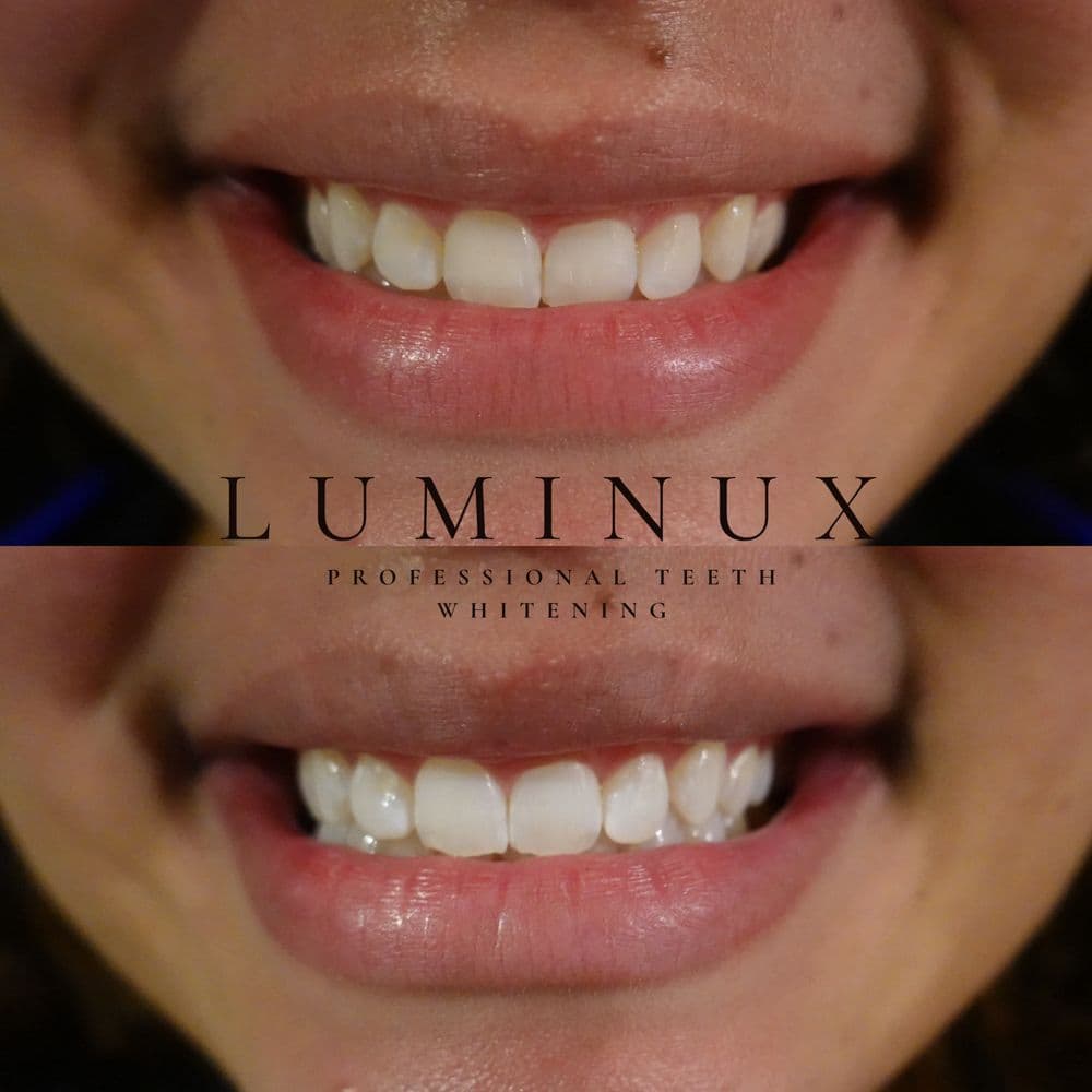 Luminux Professional Teeth Whitening